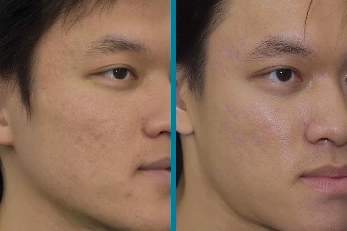 Scar Treatments Marylebone London: The Complete Guide to Regenerative Scar Solutions