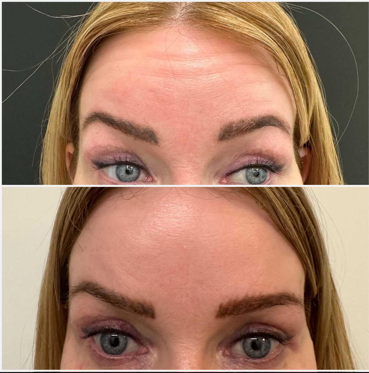 Frown Botox before and after showing forehead line reduction London clinic