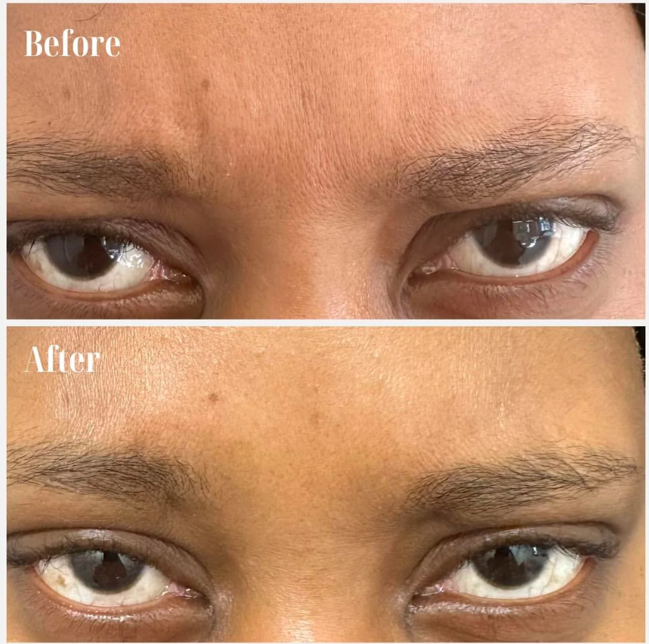 Botox before and after showing wrinkle smoothing results Mesglo London
