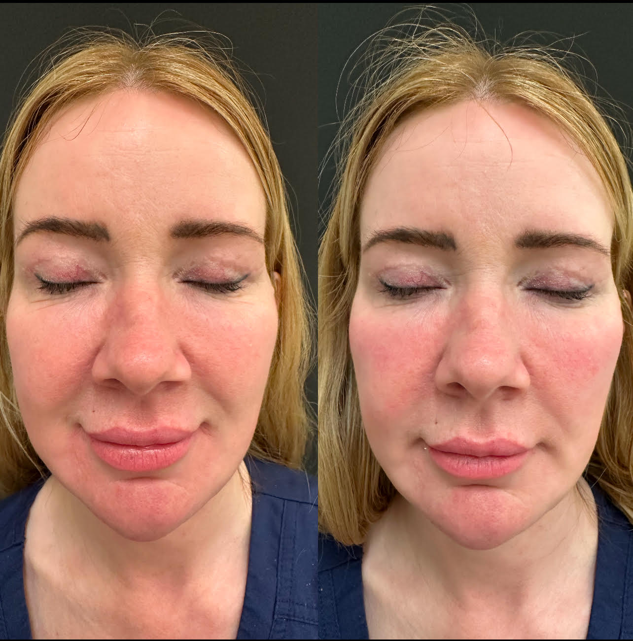 Cheek filler before and after showing facial contouring results Marylebone
