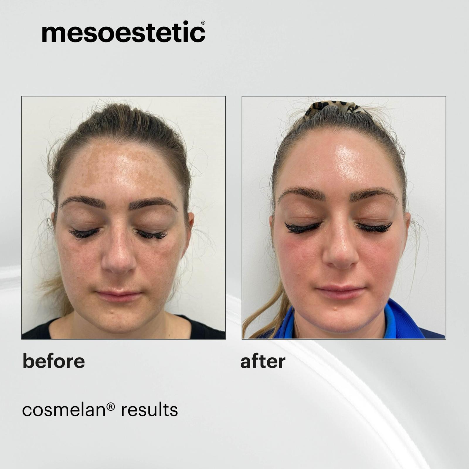 Cosmelan peeling before and after showing pigmentation reduction London