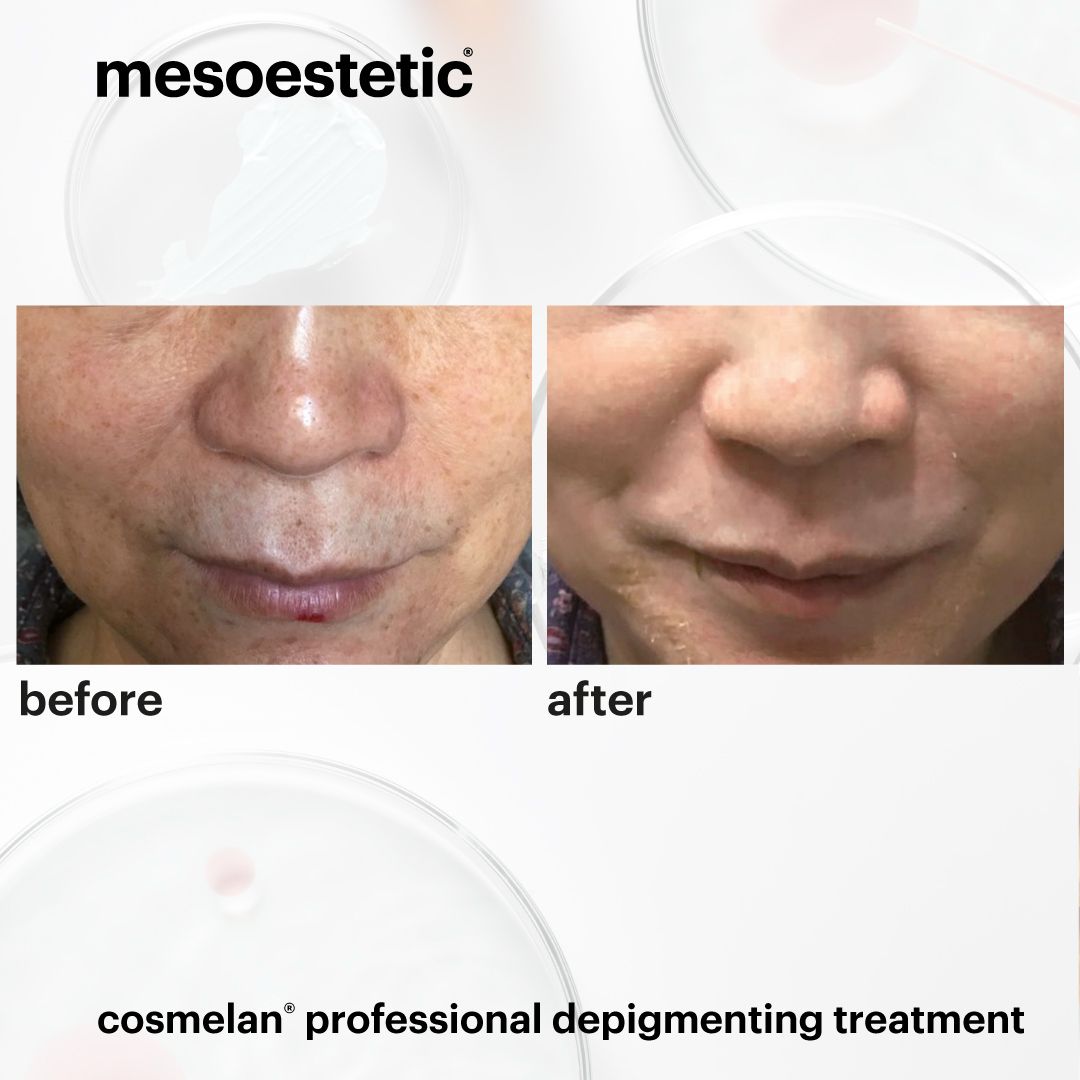 Cosmelan treatment before and after melasma treatment Marylebone clinic