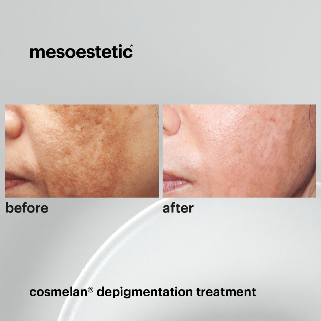 Peeling before and after showing skin clarity improvement Mesglo London