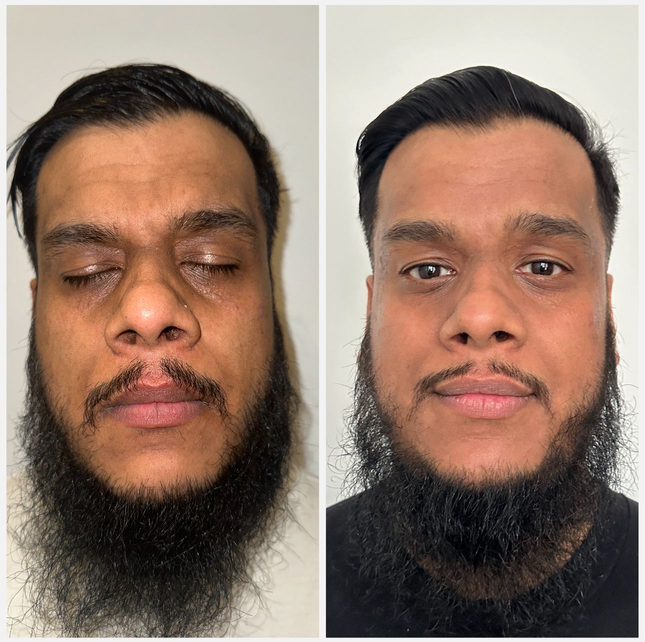 Cosmelan peel results at Mesglo London showing dramatic skin transformation