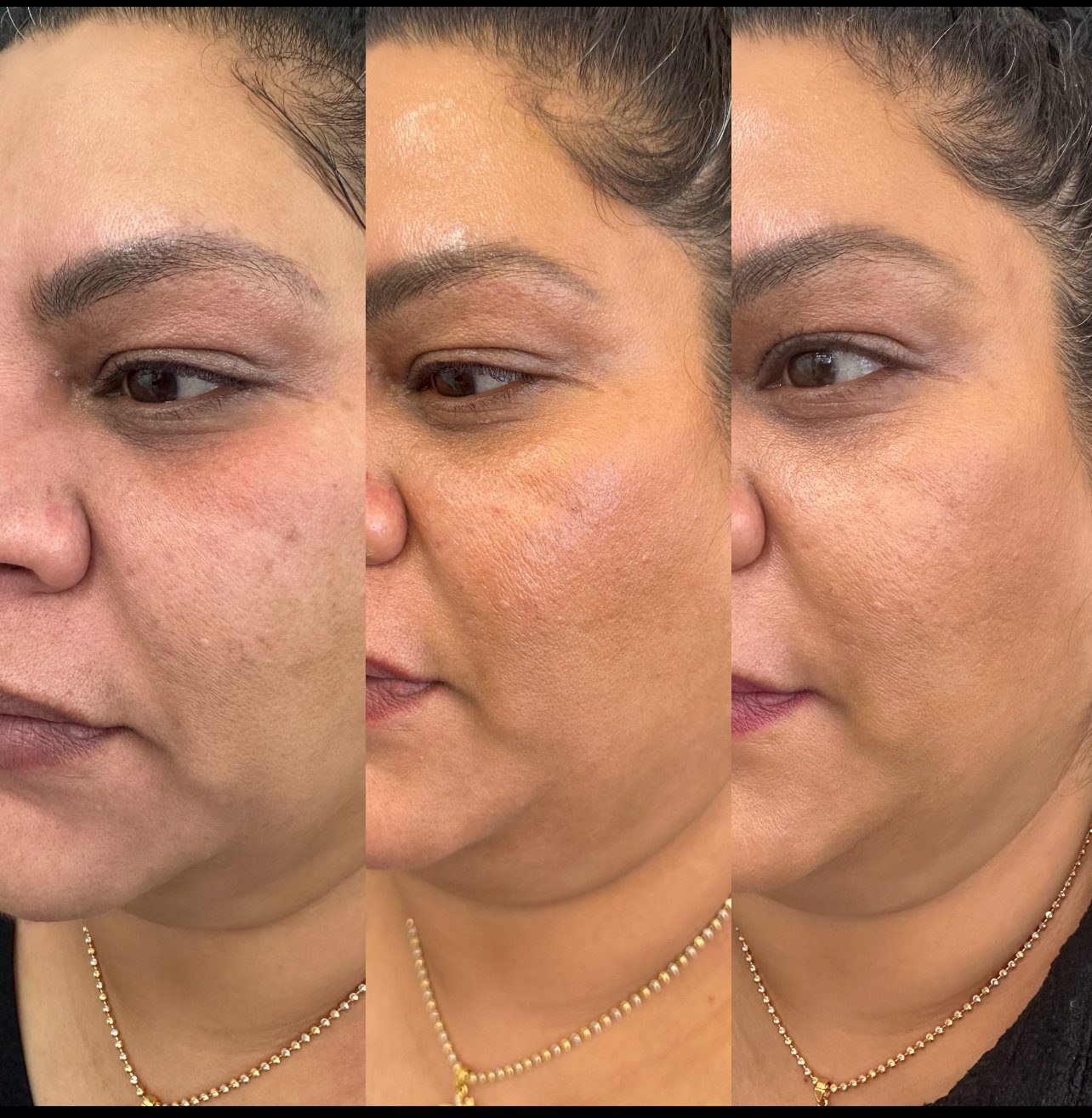 Anti-ageing exosome therapy before and after results Mesglo London clinic