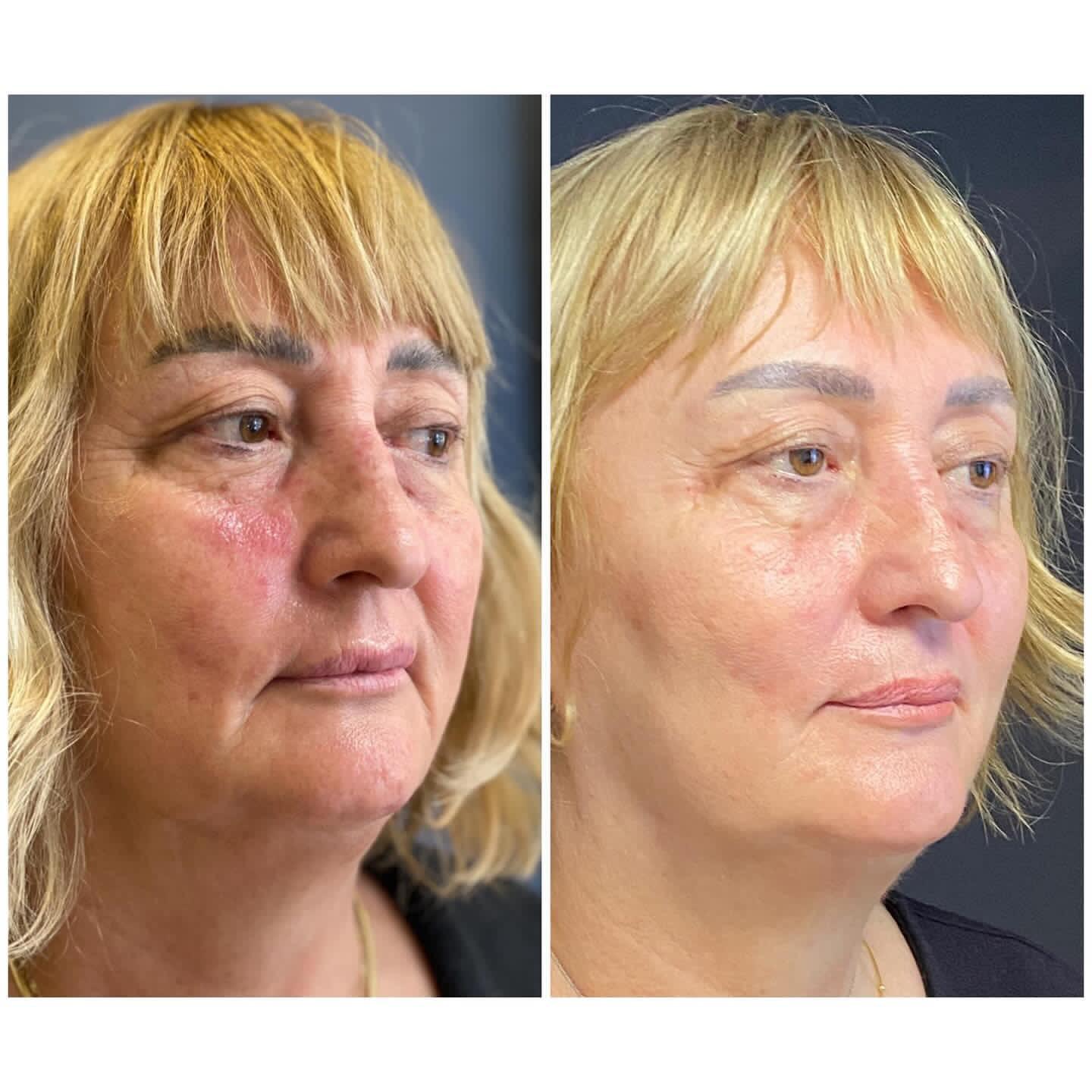 Exosome facial before and after showing dramatic skin improvement London