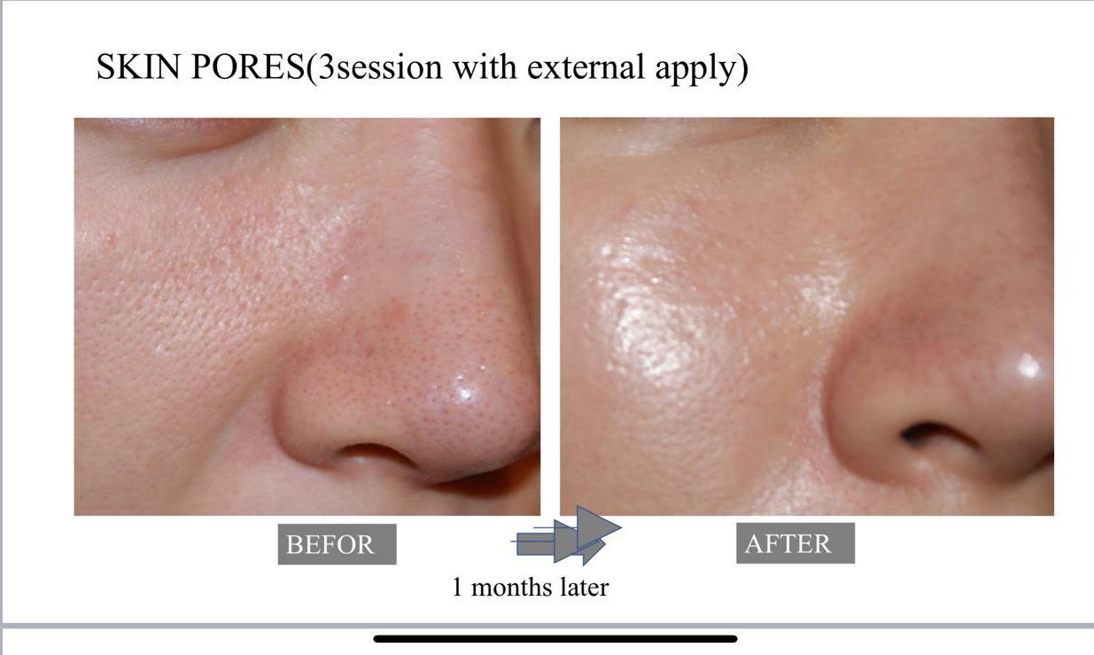 Exosome therapy before and after showing natural collagen boost results Marylebone clinic