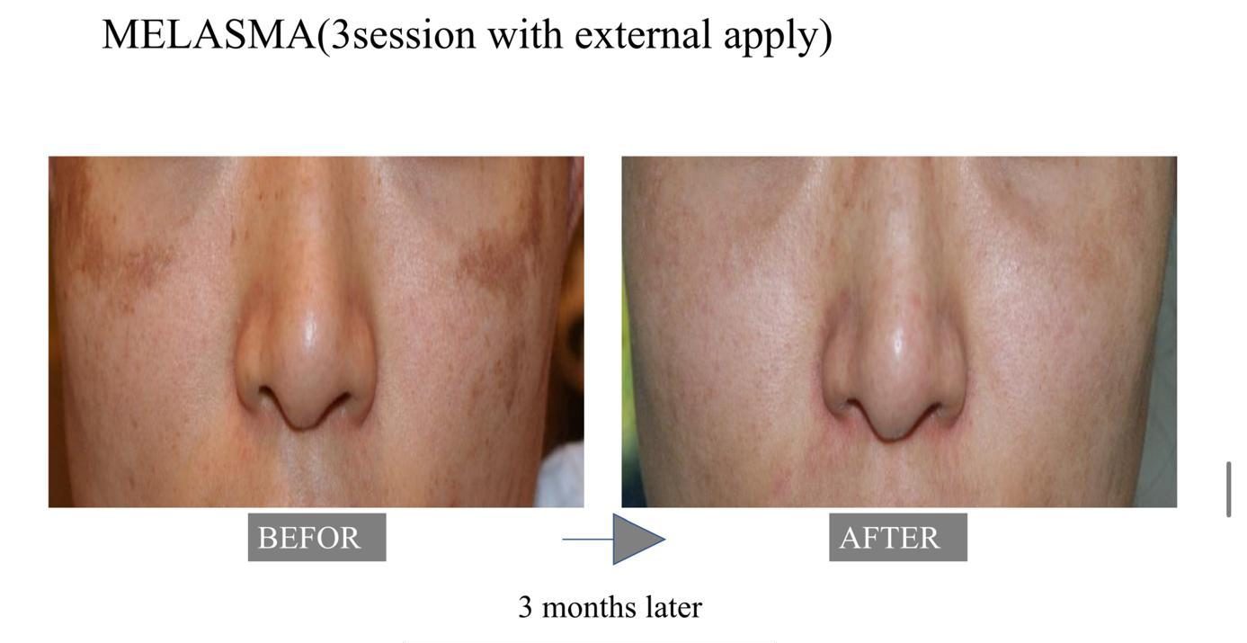 Before and after exosome treatment for dull and tired-looking skin London