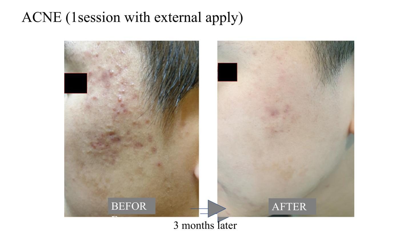 Exosome facial before and after results at Mesglo London aesthetic clinic