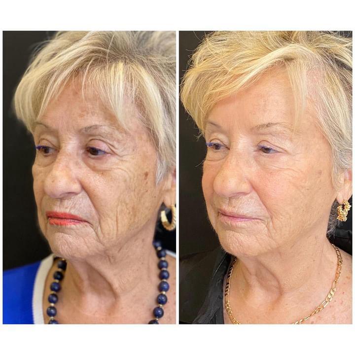 Exosome facial before and after transformation London regenerative clinic