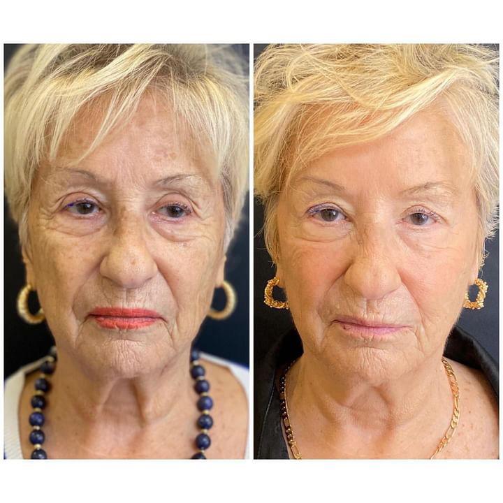 Before and after exosome treatment for fine lines reduction Marylebone