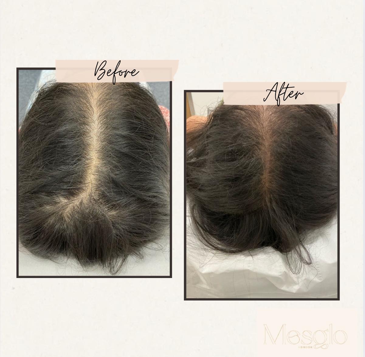 Exosomes hair before and after showing increased hair density Marylebone