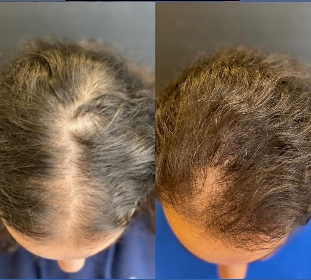 Exosomes before and after hair treatment showing follicle regeneration