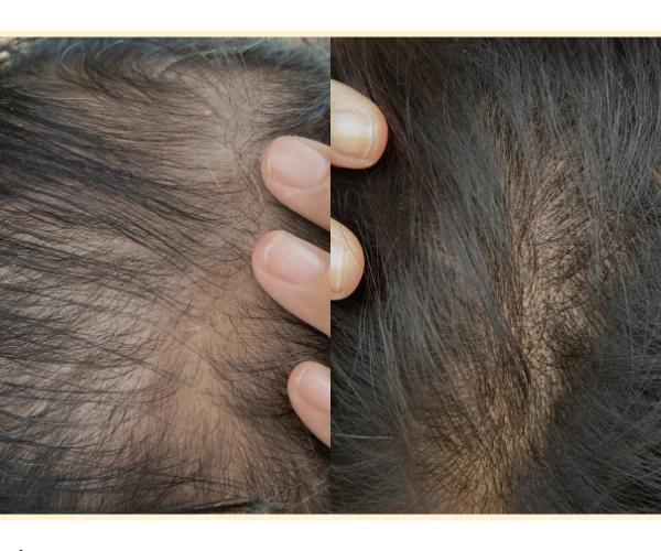 Exosome hair treatment results in London showing hair regrowth Mesglo clinic
