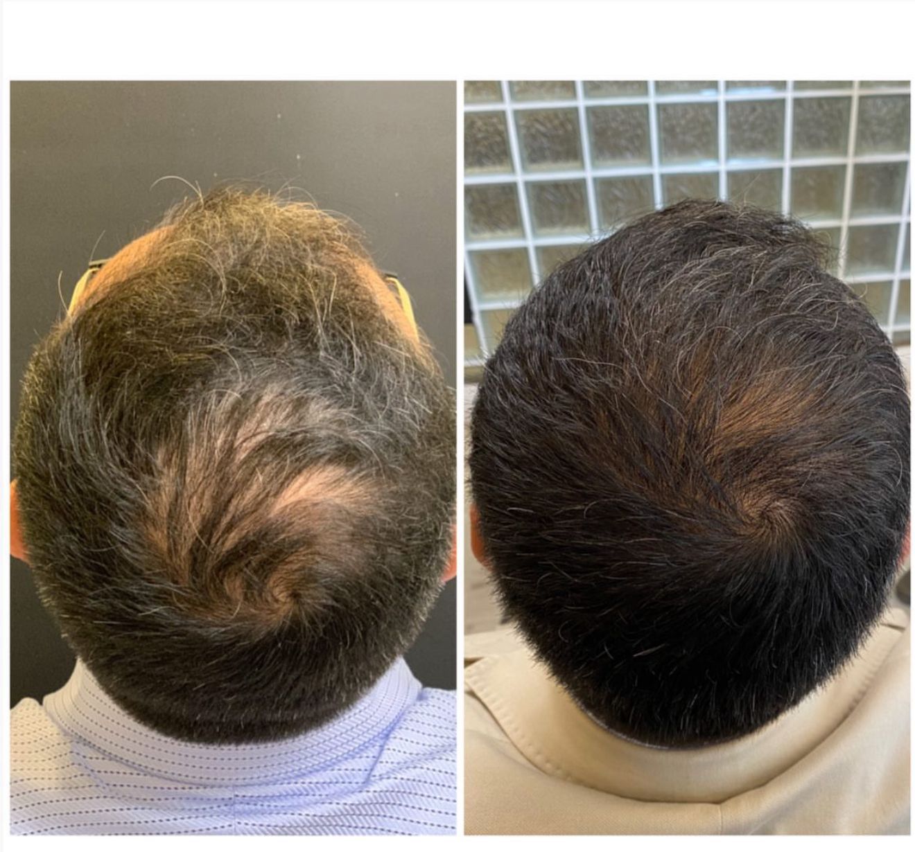 Exosomes before and after for male hair loss treatment London clinic