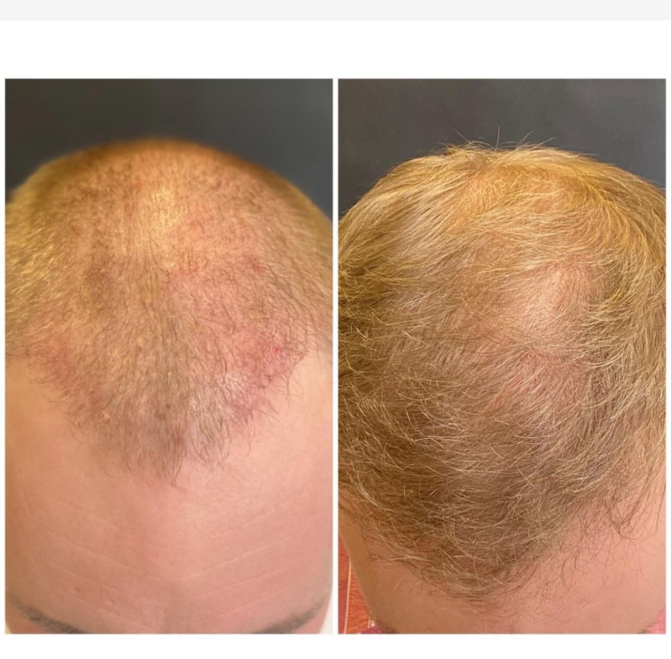Exosomes hair treatment results before and after London aesthetic clinic