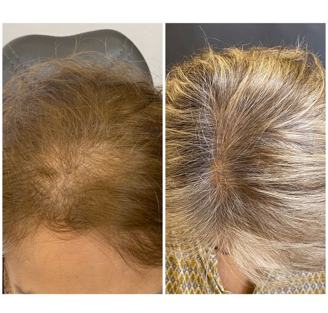 Exosomes hair therapy results showing hair thickness improvement Mesglo London