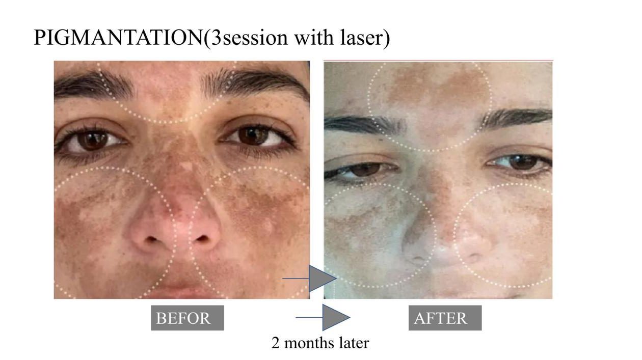 Before and after exosome facial showing hydration and radiance transformation in Marylebone