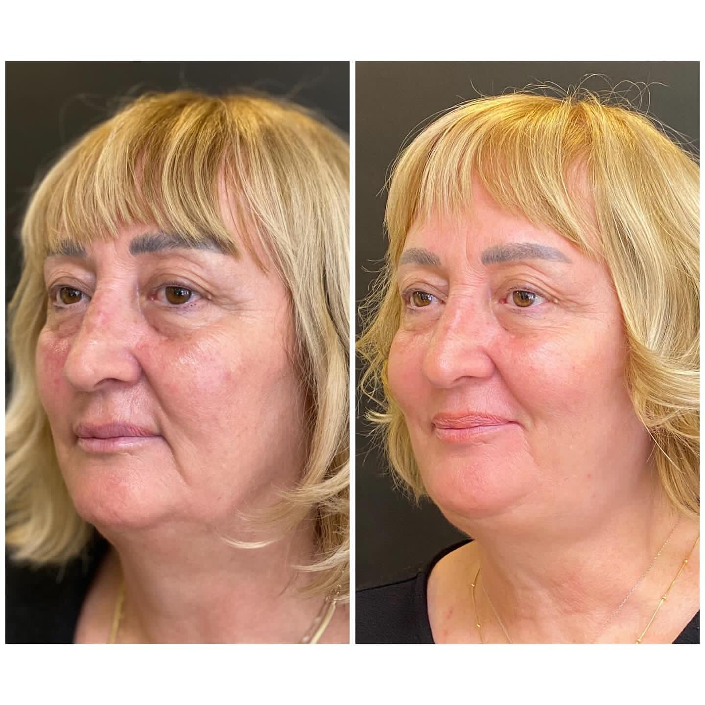 Facial rejuvenation with exosome treatment before and after Marylebone clinic