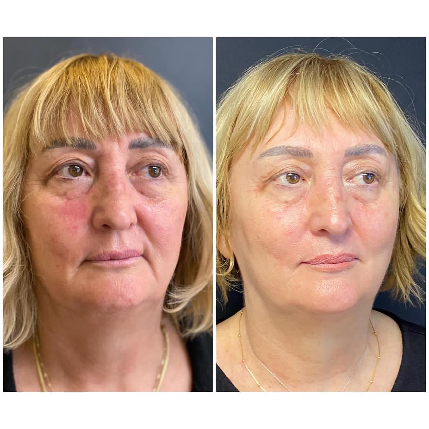 Exosome skin therapy before and after results London aesthetic treatment