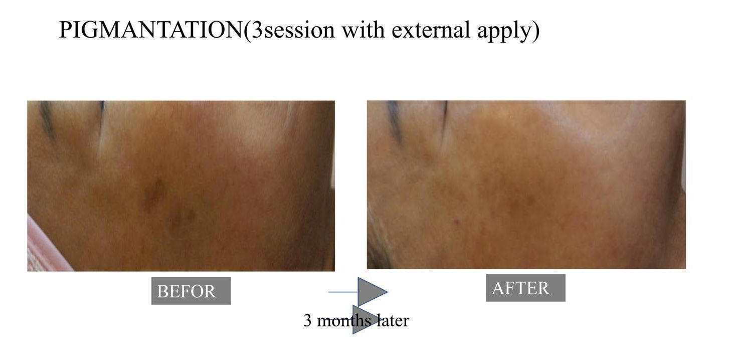 Exosome skin rejuvenation before and after showing even skin tone improvement at Mesglo London
