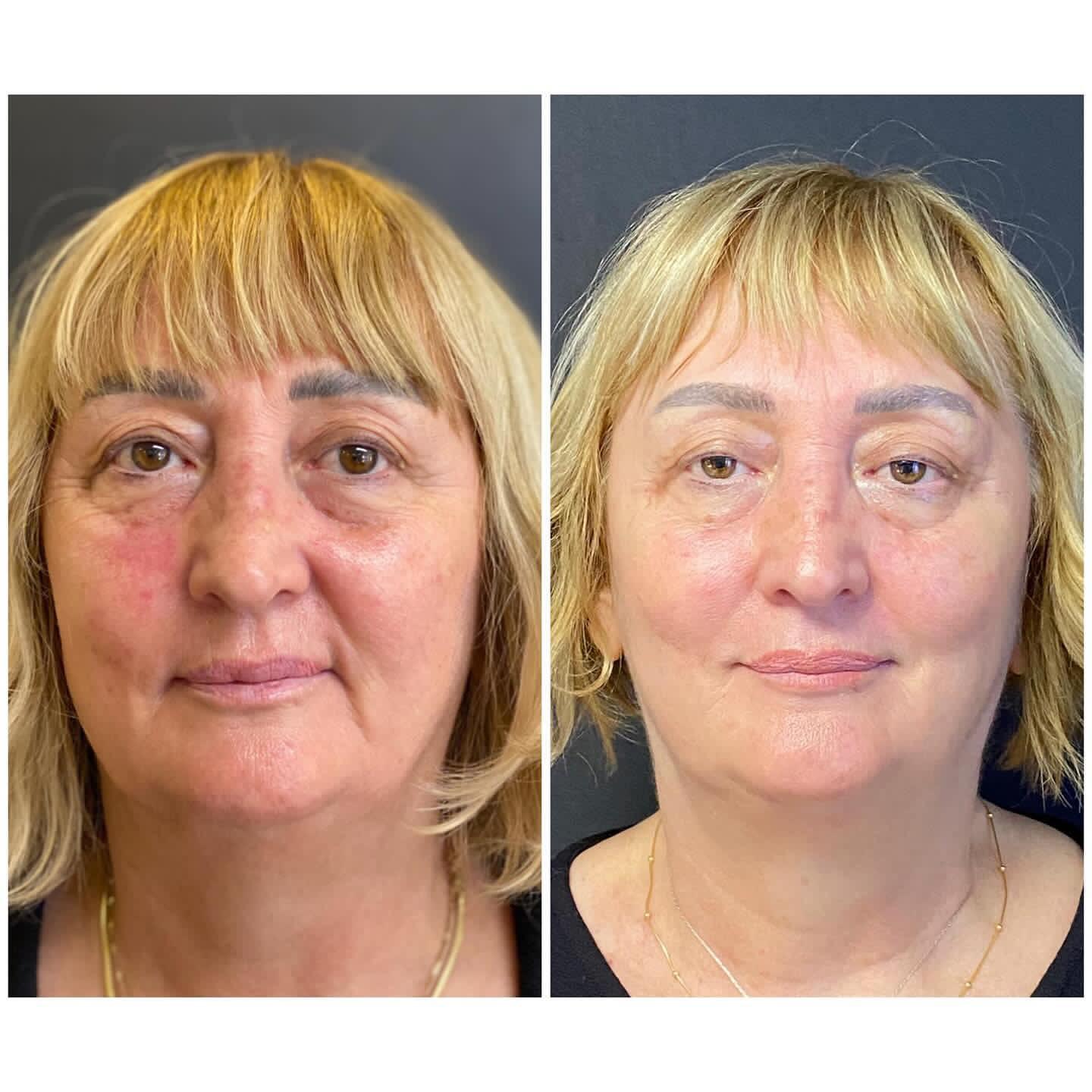 Before and after exosome therapy showing skin regeneration Mesglo London