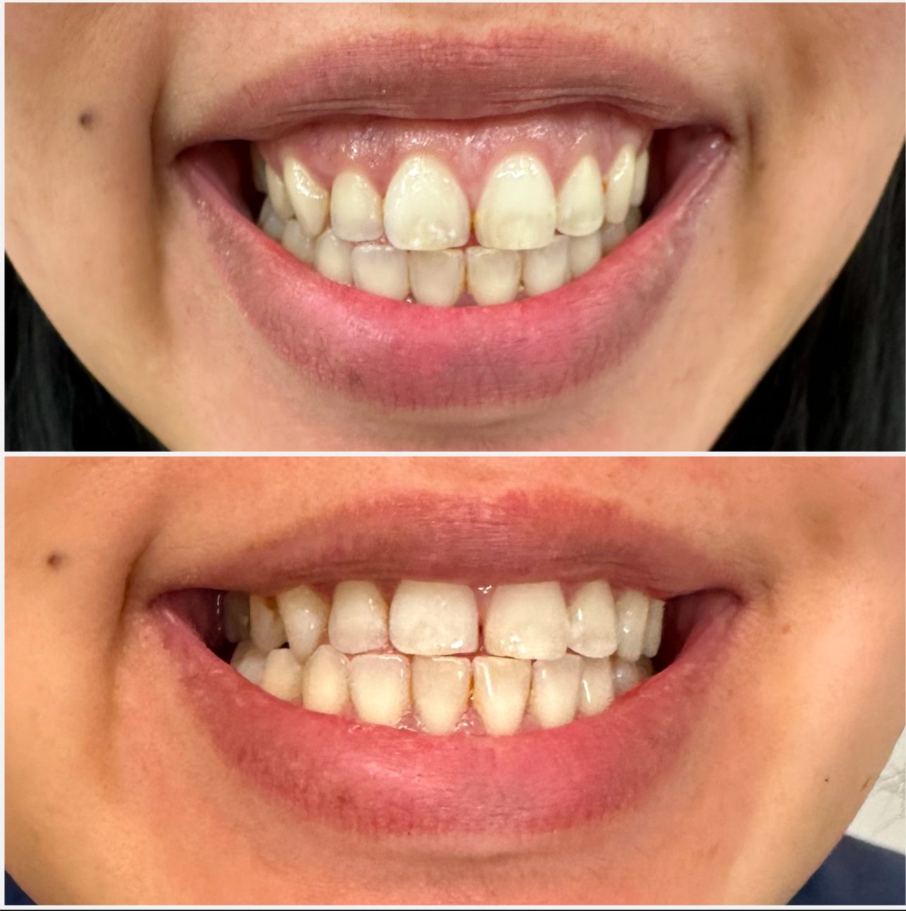 Gummy smile before and after treatment showing smile correction London