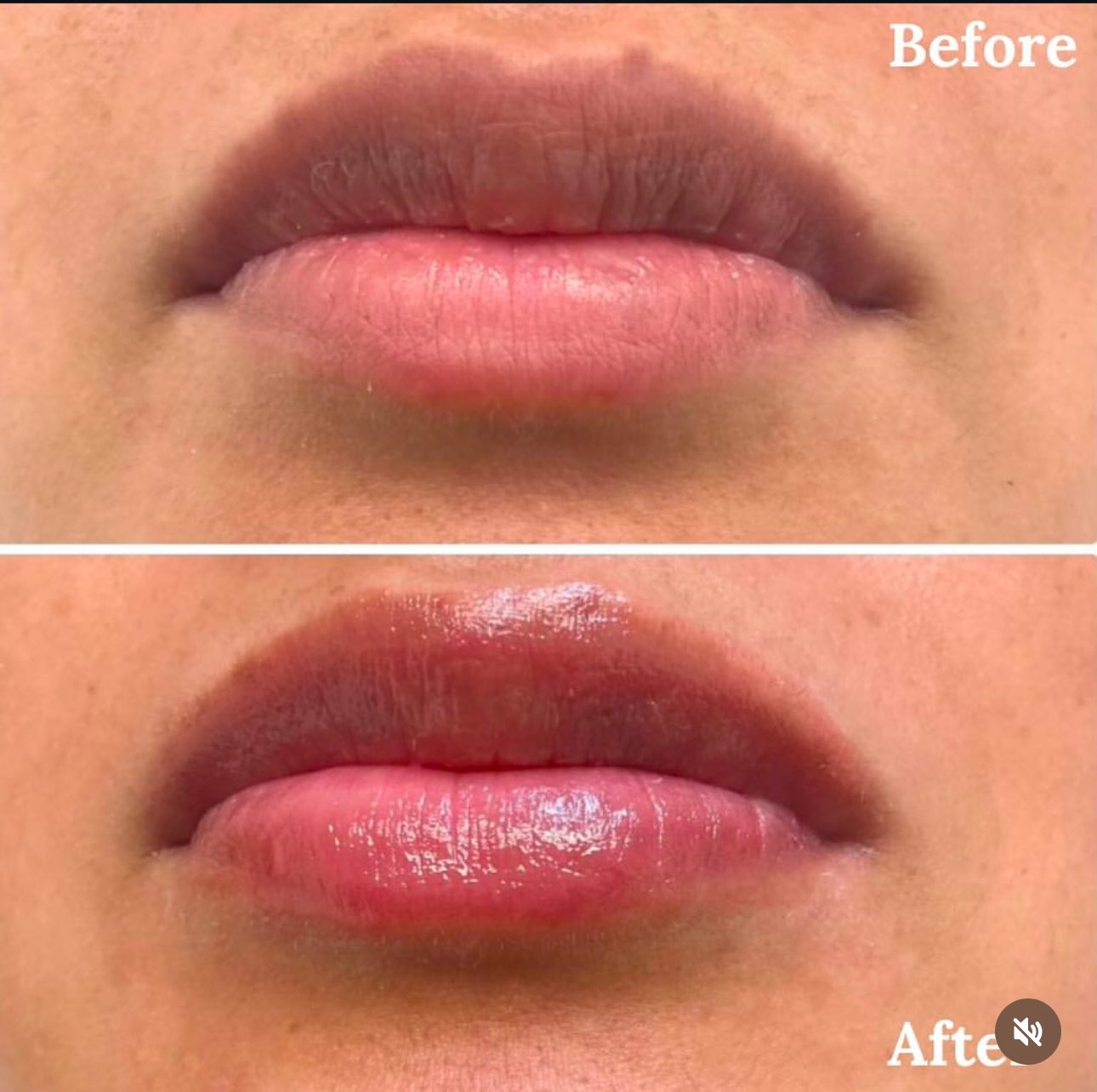 Lip enhancement before and after showing natural lip augmentation London