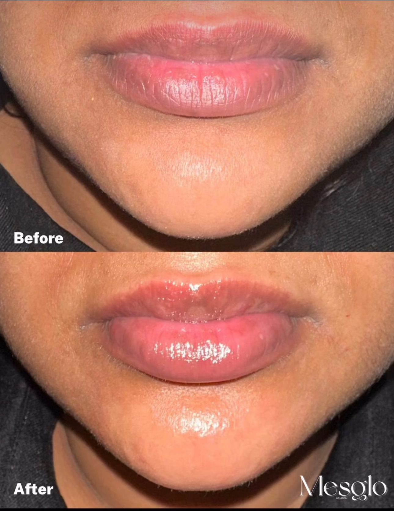 Before and after lip mesotherapy showing lip hydration and definition Marylebone