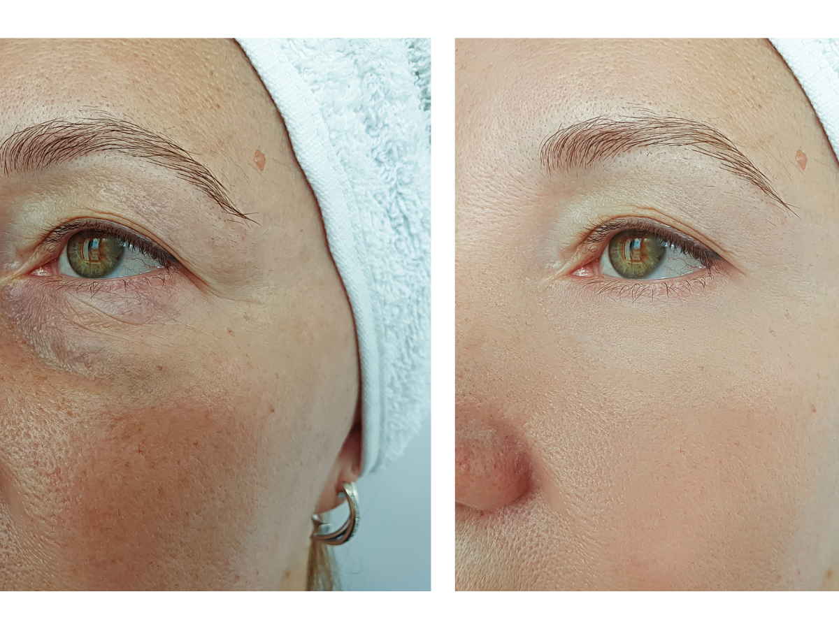 Lumi Eyes before and after showing under eye rejuvenation Mesglo London