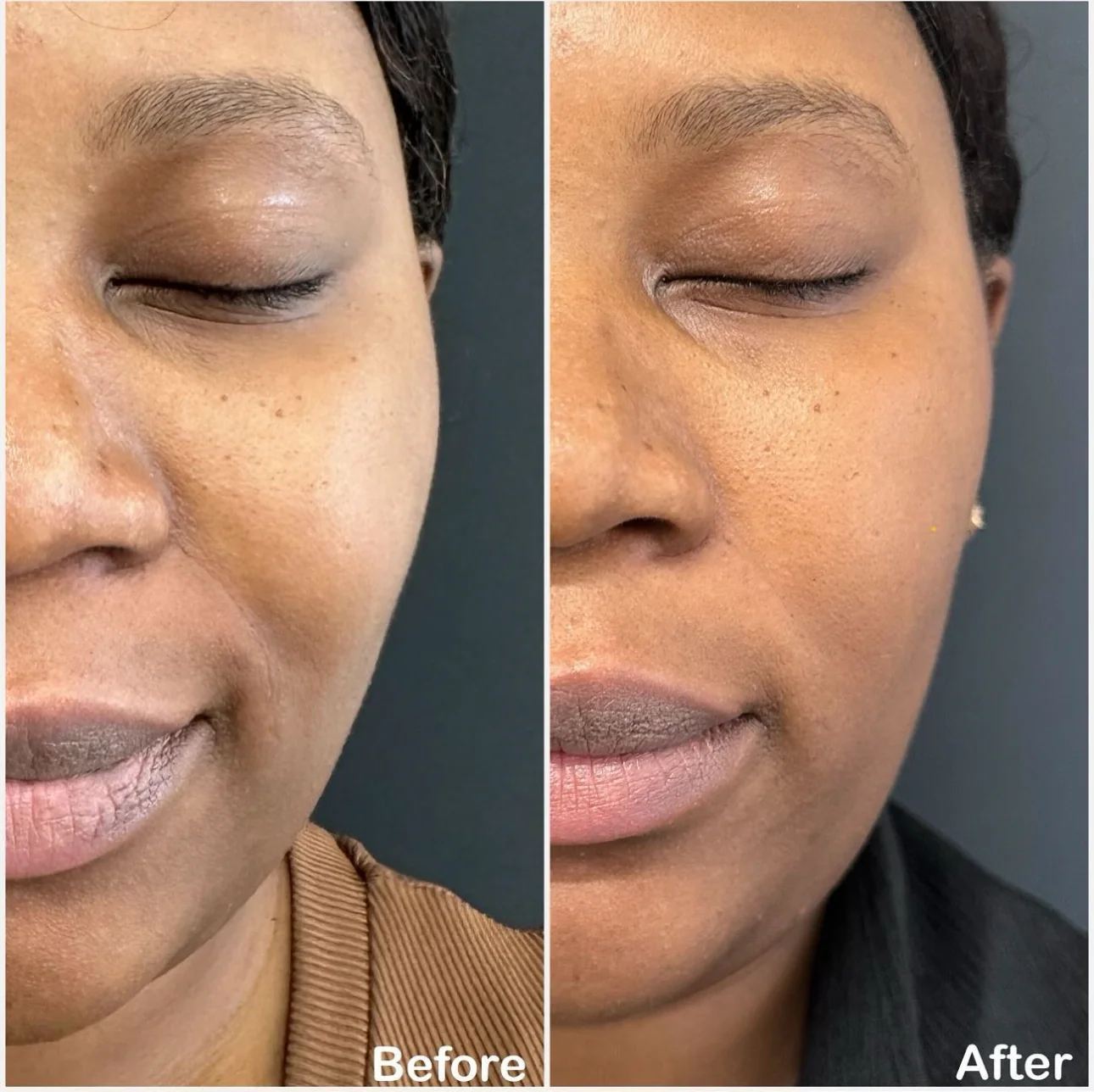 Polynucleotide face before and after showing skin regeneration London clinic